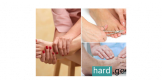 ეს რჩევები სამუდამოდ გაგათავისუფლებთ ჩაბრუნებული ფრჩხილისგან