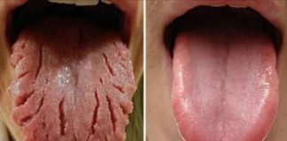 გაიგეთ რა მოგივათ თუ ენას არ გაიწმინდავთ – ექიმების გაფრთხილება