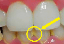 ამ მეთოდით კბილებს 5 წუთში გაითეთრებთ – ნადების გაქრობის უეფექტურესი ხერხი