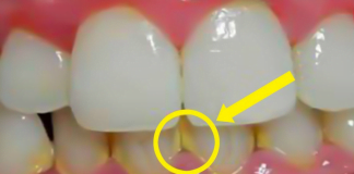 ამ მეთოდით კბილებს 5 წუთში გაითეთრებთ – ნადების გაქრობის უეფექტურესი ხერხი