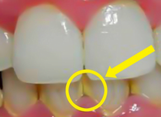 ამ მეთოდით კბილებს 5 წუთში გაითეთრებთ – ნადების გაქრობის უეფექტურესი ხერხი