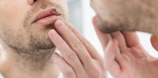 თურმე ჰერპესის მოშორება 1 დღეშია შესაძლებელი – ეს ხერხი ახლავე უნდა ისწავლოთ