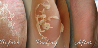 ქუსლები აღარ აგექერცლებათ – ეს მარტივი საშუალება სამოდამოდ აქრობს ქუსლის დახეთქვის რისკს