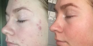 დერმატოლოგები გაგიჟებულები არიან: ამ მეთოდით მუქ წერტილებს და აკნეს 3 დღეში გაიქრობთ!