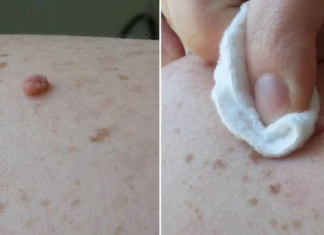 სამზარეულოს ამ პროდუქტის წასმით ხორცმეტი თავისით ჩამოვარდება – უმტკივნეულო მკურნალობის მეთოდი სახლის პირობებში