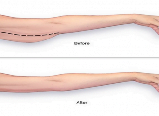 რა ეფექტი აქვს იღლიაში ლიმონის წასმას? გოგონამ ცხოვრება მთლიანად შეიცვალა
