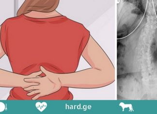 აი რატომ გტკივათ ზურგი! გაიგეთ მეტი მიზეზების და პრევენციის შესახებ!