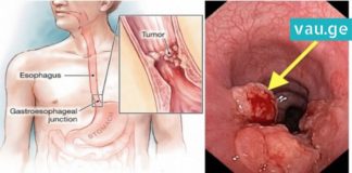 გულძმარვა – სიმპტომი, რომელიც მომავალში კიბოს იწვევს. ის, რაც უმრავლესობამ არ იცის