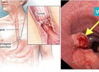გულძმარვა – სიმპტომი, რომელიც მომავალში კიბოს იწვევს. ის, რაც უმრავლესობამ არ იცის