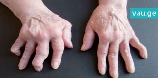 როგორ მოვირჩინოთ რევმატიზმი სახლის პირობებში? საუკეთესო გამოსავალია