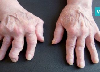 როგორ მოვირჩინოთ რევმატიზმი სახლის პირობებში? საუკეთესო გამოსავალია