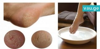 როგორ უნდა ვუშველოთ დამსკდარ და გამომშრალ ქუსლებს? ყველაზე სწრაფი მეთოდი