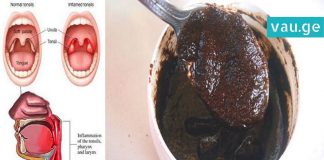 რეცეპტი, რომელიც ყელის ტკივილს 4 საათში დაგავიწყებთ! მარტივი და ეფექტურია