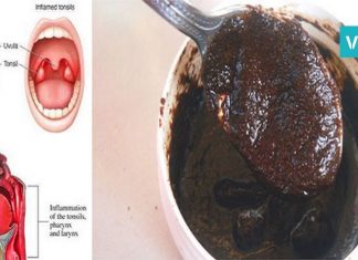 რეცეპტი, რომელიც ყელის ტკივილს 4 საათში დაგავიწყებთ! მარტივი და ეფექტურია