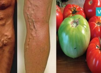 როგორ ვუმკურნალოთ ვენების ვარიკოზულ გაგანიერებას პომიდვრების დახმარებით?