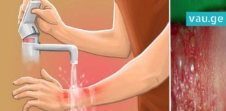 პირველი დახმარება დამწვრობის დროს – ინფორმაცია, რომელიც ყველა მშობელმა უნდა იცოდეს!