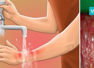 პირველი დახმარება დამწვრობის დროს – ინფორმაცია, რომელიც ყველა მშობელმა უნდა იცოდეს!