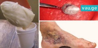 როგორ ვუმკურნალოთ ვენების თრომბოზს ამ ორი ინგრედიენტის დახმარებით? ეფექტურია