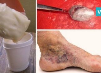 როგორ ვუმკურნალოთ ვენების თრომბოზს ამ ორი ინგრედიენტის დახმარებით? ეფექტურია