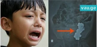 ბავშვს მუცლის არეში ტკივილი აწუხებდა. როდესაც ექიმებმა მას რენტგენი გადაუღეს…