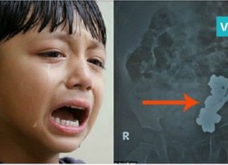 ბავშვს მუცლის არეში ტკივილი აწუხებდა. როდესაც ექიმებმა მას რენტგენი გადაუღეს…