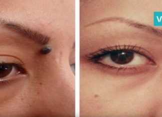 ინგრედიენტი, რომელიც არასასურველ ხალს უმტკივნეულოდ მოგაშორებთ. ეფექტურია