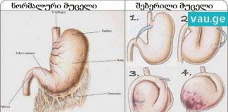 6 პროდუქტი, რომლის მიღება მუცლის შებერილობას სამუდამოდ დაგავიწყებთ