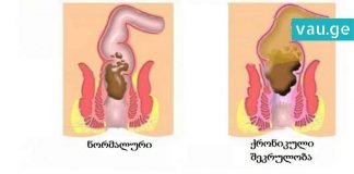 როგორ მოვიქცეთ კუჭში შეკრულობის დროს? ყველაზე ეფექტური მეთოდი