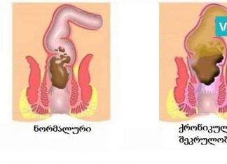როგორ მოვიქცეთ კუჭში შეკრულობის დროს? ყველაზე ეფექტური მეთოდი