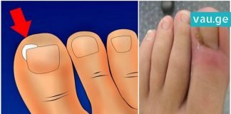 როგორ ვუმკურნალოთ ჩაზრდილ ფრჩხილს სახლის პირობებში? ყურადსაღებია