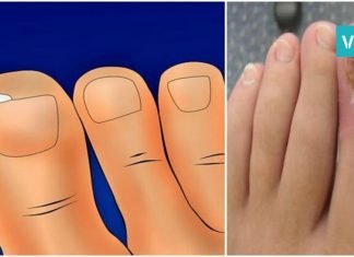 როგორ ვუმკურნალოთ ჩაზრდილ ფრჩხილს სახლის პირობებში? ყურადსაღებია