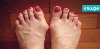 როგორ მოვიქცეთ ტერფის დეფორმაციის დროს? რეცეპტი, რომელიც ბევრს გამოადგება