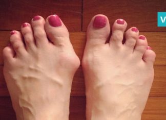 როგორ მოვიქცეთ ტერფის დეფორმაციის დროს? რეცეპტი, რომელიც ბევრს გამოადგება