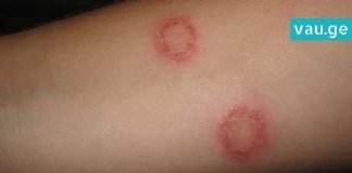 სირსველი – კანის დაავადება, რომელიც სხვისი სამოსიდან ან პირსახოციდან შეიძლება გადაგედოთ