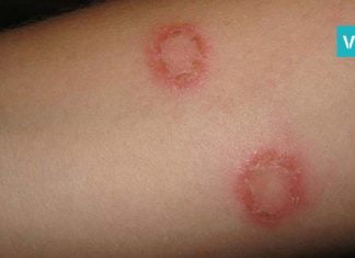 სირსველი – კანის დაავადება, რომელიც სხვისი სამოსიდან ან პირსახოციდან შეიძლება გადაგედოთ