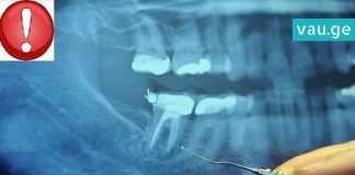 კიბოთი დაავადებამდე ადამიანების 97% ამ პროცედურას იტარებდა. საჭირო ინფორმაციაა