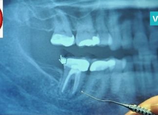 კიბოთი დაავადებამდე ადამიანების 97% ამ პროცედურას იტარებდა. საჭირო ინფორმაციაა