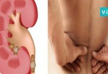 როგორ გავათავისუფლოთ თირკმელები კენჭებისგან? ყველაზე ეფექტური და სასარგებლო სიროფი