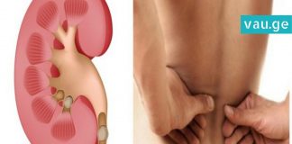 როგორ გავათავისუფლოთ თირკმელები კენჭებისგან? ყველაზე ეფექტური და სასარგებლო სიროფი