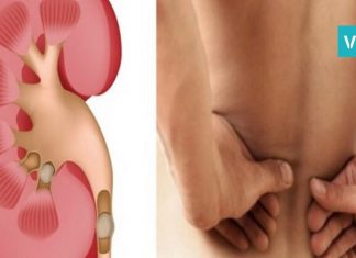 როგორ გავათავისუფლოთ თირკმელები კენჭებისგან? ყველაზე ეფექტური და სასარგებლო სიროფი