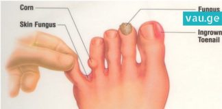 3 ინგრედიენტი, რომელიც ფრჩხილის სოკოს სამუდამოდ დაგავიწყებთ. ყველაზე ეფექტურია