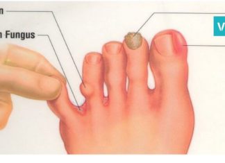 3 ინგრედიენტი, რომელიც ფრჩხილის სოკოს სამუდამოდ დაგავიწყებთ. ყველაზე ეფექტურია