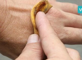 საუკეთესო ინგრედიენტი მეჭეჭების მოსაშორებლად. ყველაზე ეფექტური და სწრაფი ხერხია