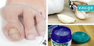 როგორ ვებრძოლოთ ფრჩხილის სოკოს? 6 ეფექტური პროდუქტი, რომელიც ამ დაავადებას დაგავიწყებთ