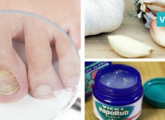 როგორ ვებრძოლოთ ფრჩხილის სოკოს? 6 ეფექტური პროდუქტი, რომელიც ამ დაავადებას დაგავიწყებთ