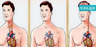 როგორ განვასხვაოთ ერთმანეთისგან ინსულტი, ინფარქტი და გულის გაჩერება?