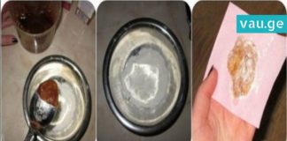 კომპრესი ძლიერი ხველებისთვის ერთ საღამოში განიკურნებით!-ეფექტურია ბავშვებისთვის