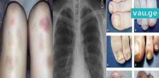 10 სიმპტომი, რომელთა იგნორირება მომავალში კიბოს იწვევს. ყურადსაღები ინფორმაციაა