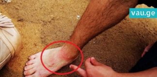 როგორ უნდა მოიქცეთ მედუზის დასუსხვის დროს? 3 რამ რაც სასტიკად იკრძალება