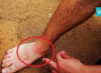 როგორ უნდა მოიქცეთ მედუზის დასუსხვის დროს? 3 რამ რაც სასტიკად იკრძალება